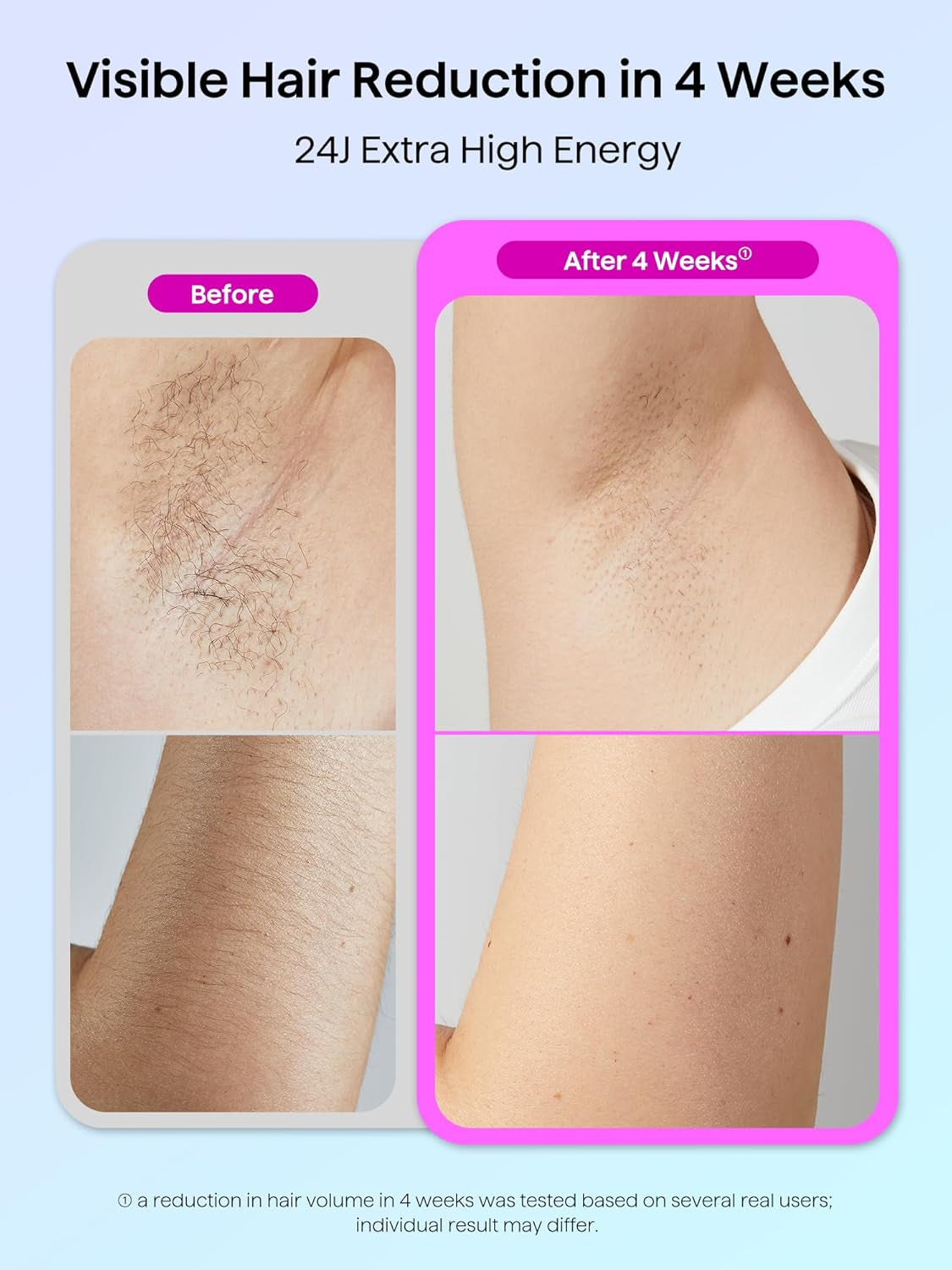 Laser Hair Removal for Women and Men,Ipl Hair Removal with Ice Cooling Function for Nearly Painless and Long-Lasting Results,24J High Energy IPL Laser Hair Removal for Armpits Legs Arms Bikini,Corded