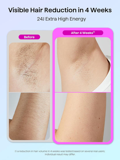 Laser Hair Removal for Women and Men,Ipl Hair Removal with Ice Cooling Function for Nearly Painless and Long-Lasting Results,24J High Energy IPL Laser Hair Removal for Armpits Legs Arms Bikini,Corded